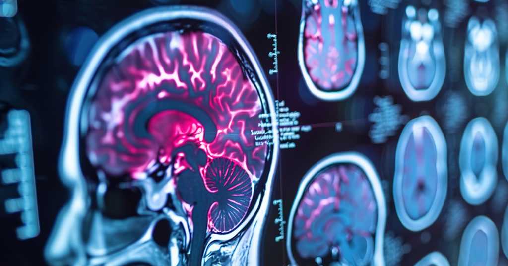 Rewiring Hope: Equiscope Protocols and a 12-Year-Old’s Remarkable Recovery from Grade 3 Diffuse Axonal Injury