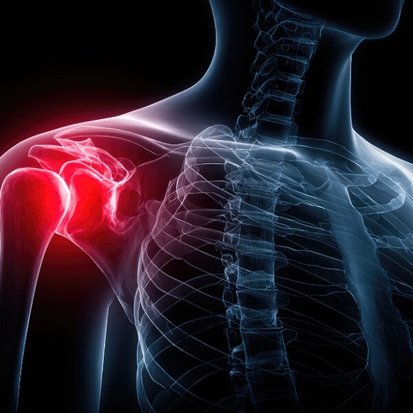 Restoring Range: How Equiscope Protocols Provided Relief in a Shoulder-Stiffness Case
