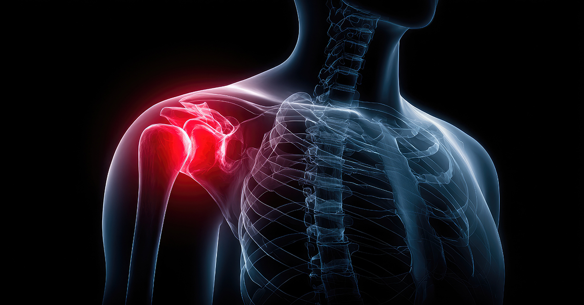 Restoring Range: How Equiscope Protocols Provided Relief in a Shoulder-Stiffness Case